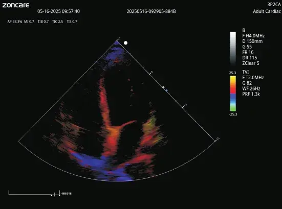 Kardiyak renkli doppler