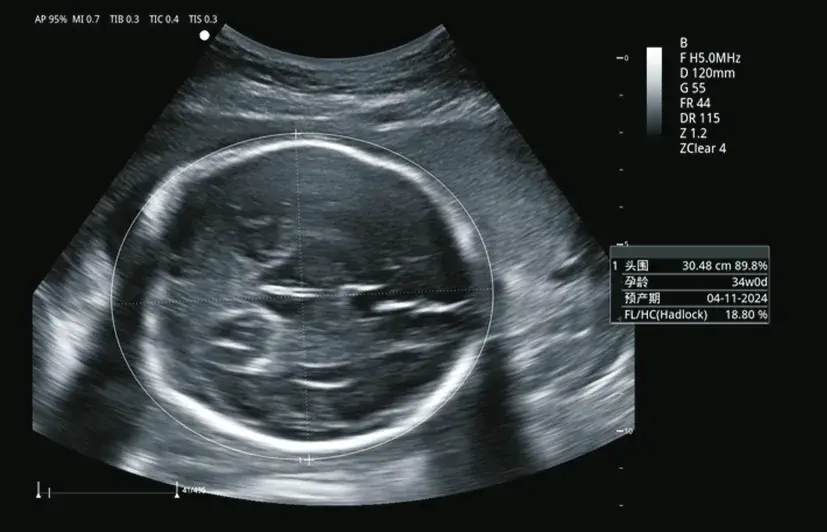 Fetal biyometri